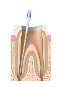 歯の神経の除去